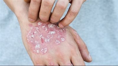 منها الحكة والألم، أعراض وأنواع الصدفية المختلفة 