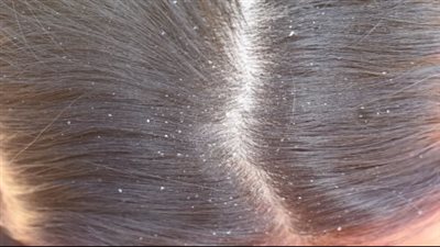 أفضل طريقة للتخلص من قشرة الشعر فى الشتاء| فيديو 