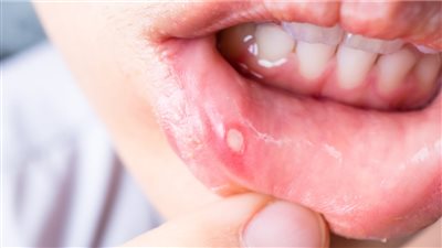 علاج تقرحات الفم بالمنزل، وهذه أسبابها 