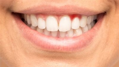 كيف تستخدم غسول الفم الطبيعي لعلاج التهاب اللثة؟