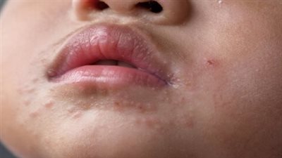 ما هي أسباب ظهور حبوب تحيط بالفم والأنف عند الأطفال؟