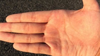 أسباب جفاف الجلد في بداية فصل الشتاء