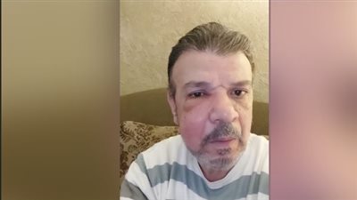 أحمد سلامة ينشر صورته بكدمة في العين وورم بالخد ويعلق: الحمد لله.. قدر الله وما شاء فعل