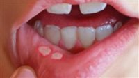 علاج فطريات الفم بالمنزل وأسباب الإصابة بها 