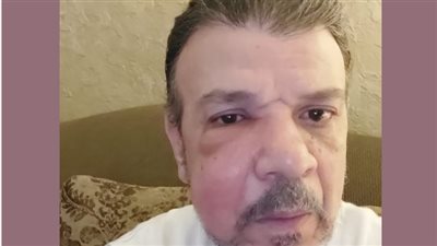 خضع لعملية جراحية.. آخر تطوارت الحالة الصحية للفنان أحمد سلامة 