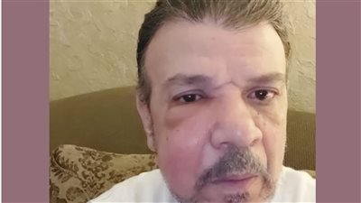 أحمد سلامة يعلن تعافيه من إصابته في الوجه