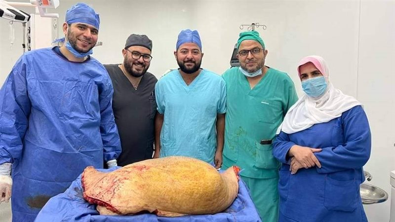 استئصال فتق ودهون