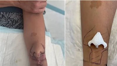 بعد نموه على ذراعها.. أول عملية زراعة أنف على وجه إمرأة فرنسية