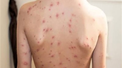علاج الجدري المائي.. وأسباب الإصابة والأعراض