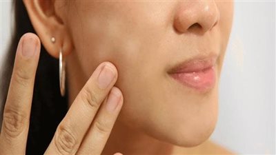 طرق علاج البقع البيضاء في البشرة والجسم 