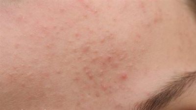 كيفية علاج حبوب تحت الجلد بالوجه في المنزل