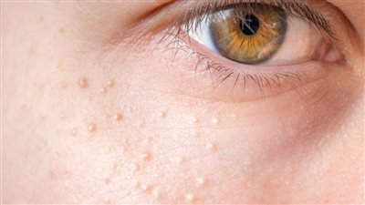  استشاري يوضح طرق علاج الحبوب أسفل الجلد 