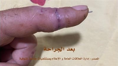 فريق بالمستشفى الجامعى بالمنوفية ينجح في إعادة توصيل أصابع مبتورة