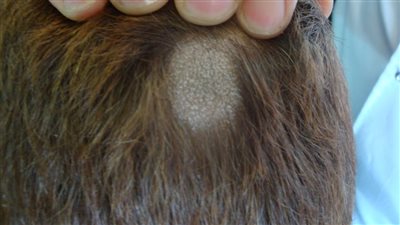 استشاري يوضح أعراض وعلاج الثعلبة عند الأطفال 