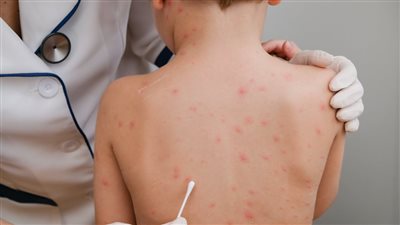 بعد رصد إصابات بالفيروس، خطة الصين لاحتواء جدري القرود على طريقة 