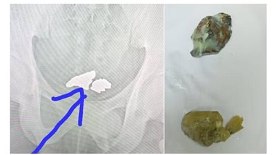 موظف في الكونغو يسرق 81 جرام ذهب وخفيها في أمعائه