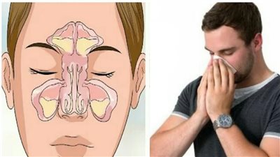 أعراض الجيوب الأنفية.. وأفضل علاج بالقرفة والزنجبيل والريحان