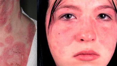 أعراض وعلامات مرض الذئبة، ومتى تذهب للطبيب؟