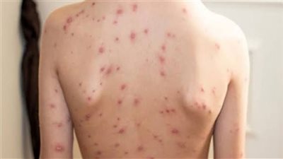 علاج الجدري المائي وطرق اكتشاف الإصابة والأسباب