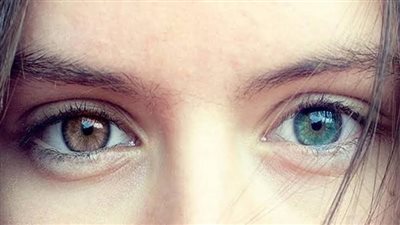 خلل جيني.. تفسير تغاير لون العينين في بعض الأشخاص