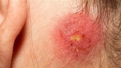 حقيقة خطر انتشار بكتيريا المكورات العنقودية في مصر والدول العربية