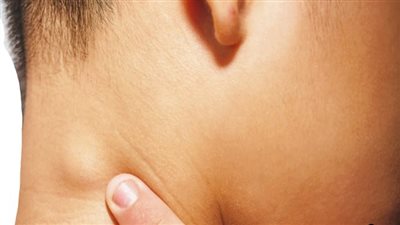 كاواساكي، الأطباء يحذرون من مرض ينتشر بين الأطفال