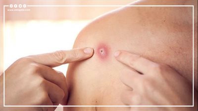 رسالة طمأنة من فاكسيرا عن فيروس جدري القرود 