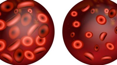 أعراض فقر الدم وطرق العلاج بالتغذية السليمة