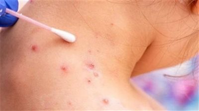 المصل واللقاح: إصابات جدري القرود لا تدعو للرعب وهذا سبب انتشارها في أوروبا