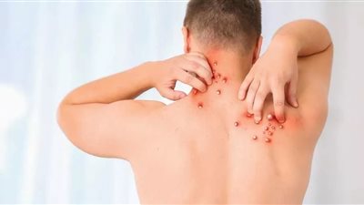  الصحة توضح إجراءات عزل حالات الاشتباه بالإصابة بفيروس جدري القرود 