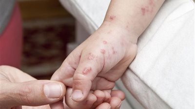 تعرف على أعراض جدري القرود، وكيف ينتقل من شخص لآخر؟