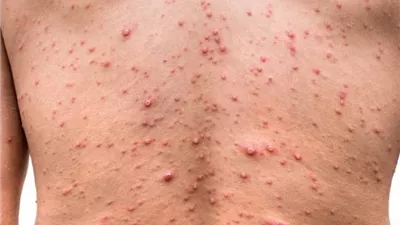 الصحة تكشف فرص انتشار جدري القرود في مصر وسرعة العدوى به وتوضح هل تحول لجائحة تشبه فيروس كورونا؟ وهذه أعراض المرض وطرق انتقاله