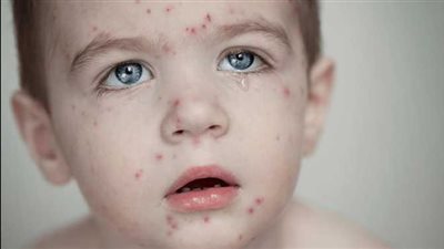 قد تؤدي للوفاة، مضاعفات وأعراض الحصبة