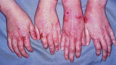 علاج جديد يبشر بنهاية معاناة مصابين بمرض جلدي نادر 