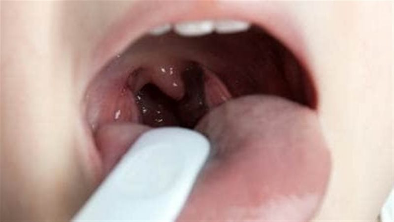 علاج التهاب الحلق،