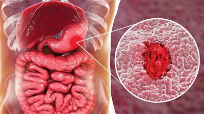 أعراض جرثومة المعدة، وطرق العلاج والوقاية