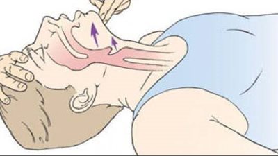 بلع اللسان، كيف يحدث وأهم الإسعافات الأولية 