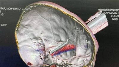 استخراج جسم معدني من رأس طفل في مستشفى طوارئ المنصورة 