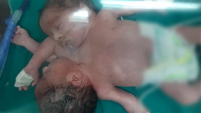 نجاح ولادة توأم ملتصق بمستشفى جامعة المنصورة