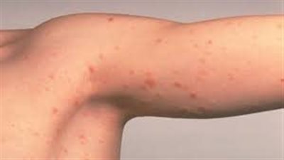 النخالة الوردية، التشخيص والأعراض وأسباب الإصابة بها