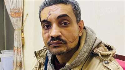 144 غرزة في الوجه.. ياسر تدخل لحل مشكلة فخرج بعاهة مستديمة ويؤكد: مش هسيب حقي بالقانون (فيديو صور)