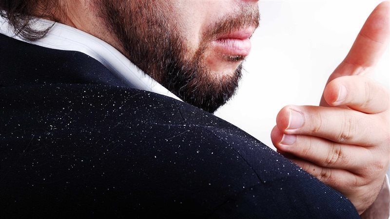 قشرة الشعر، فيتو