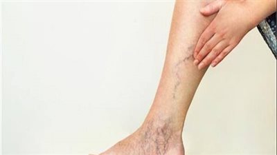 أبرزها التدخين والكوليسترول، أعراض وأسباب انسداد الشرايين