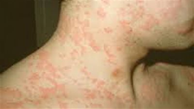 طرق الوقاية من أعراض الأرتيكاريا المزمنة بالمنزل