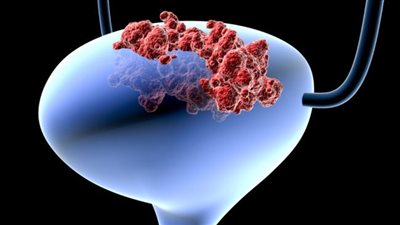 باحث يحذر من دواء لعلاج السكر يسبب سرطان المثانة