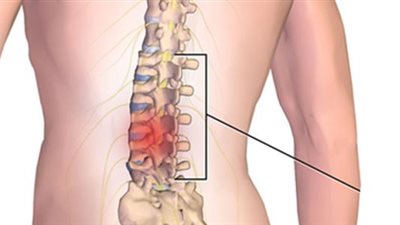 أسباب الإصابة بالانزلاق الغضروفي
