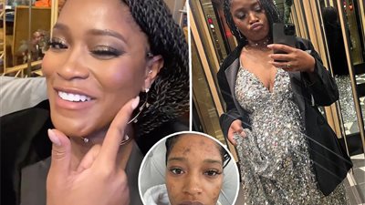 كيكي بالمر: الحمل أفضل علاج لحبوب الوجه