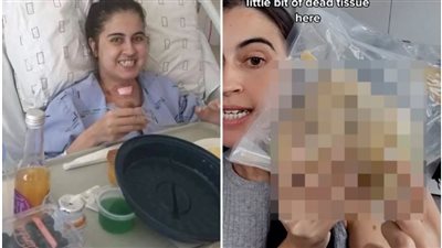 مواطنة تحتفظ بقلبها القديم بعد إجراء عملية زراعة ناجحة (صور)