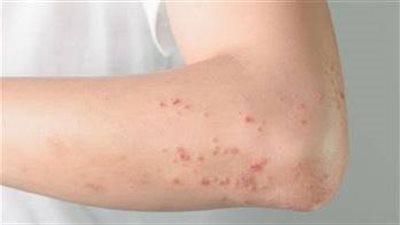 يبدأ بتقرحات في الفم واللسان وينتهي بالعمى، احذر من أعراض مرض بهجت