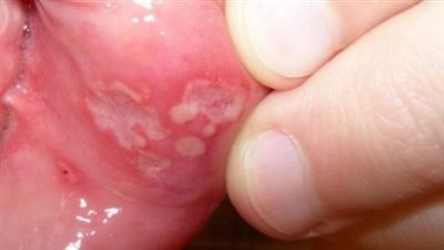 أعراض مرض بهجت